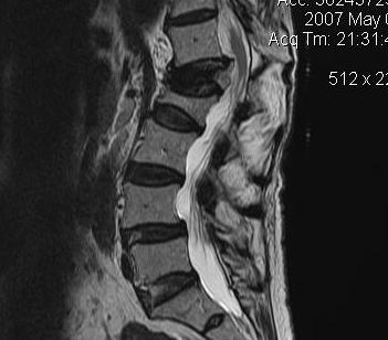 Lumbar Metastasis MRI